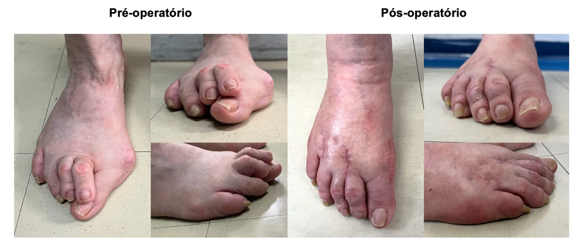 Pré-operatório e pós-operatório real de cirurgia de joanete